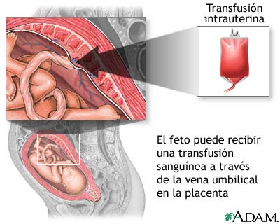 trasfusion intrauterina